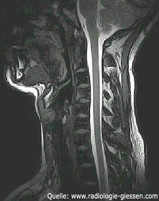 Hier ist ein Röntgenbild des Kopfes und der Halswirbelsäule abgebildet.